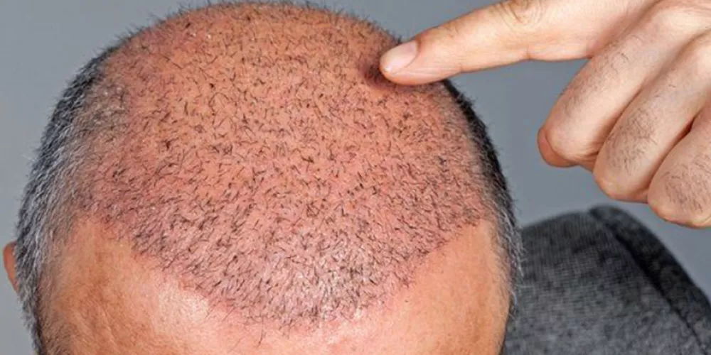 Trapianti di capelli in uno studio non autorizzato, grave una donna: scattano due denunce